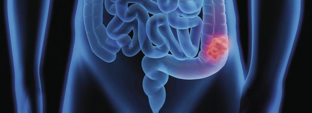 Adenome verständlich erklärt: Was Sie darüber wissen sollten