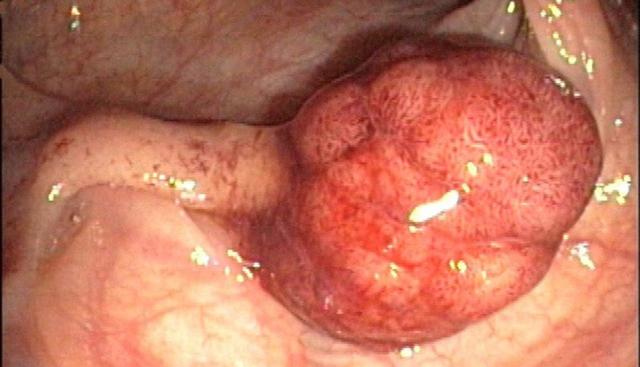 Alles, was Sie über Adenome wissen müssen