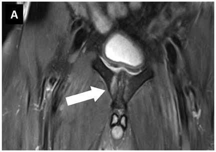Knochenmarködem: Diagnoseverfahren, Behandlungsoptionen und Prognose Knochenmarködem: Diagnoseverfahren, Behandlungsoptionen und Prognose