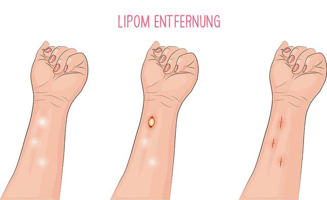 Lipome: Harmlose Fettgeschwulste unter der Haut