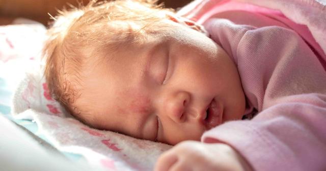 5. Wie lange dauert es, bis ein Storchenbiss verschwindet?