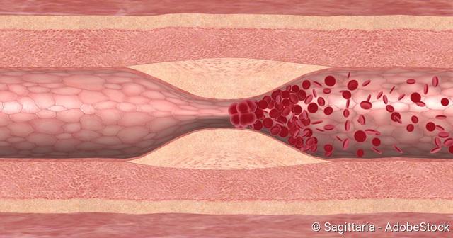 6. Embolie: Symptome je nach betroffenem Körperbereich