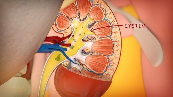 Nierenkolik, Gallensteinkolik und mehr: Ein Überblick über verschiedene Arten von Koliken Nierenkolik, Gallensteinkolik und mehr: Ein Überblick über verschiedene Arten von Koliken