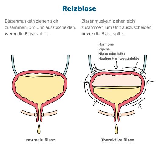 Reizblase: Tabuthema? Offen mit dem Arzt sprechen und Beschwerden lindern Reizblase: Tabuthema? Offen mit dem Arzt sprechen und Beschwerden lindern