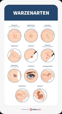 Viruswarzen: Häufigkeit, Verlauf und Risikofaktoren Viruswarzen: Häufigkeit, Verlauf und Risikofaktoren