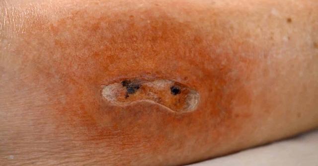 Chirurgisches Débridement bei nekrotischem Gewebe: Ablauf und Bedeutung Chirurgisches Débridement bei nekrotischem Gewebe: Ablauf und Bedeutung