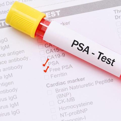 Vorsichtsmaßnahmen vor einem PSA-Test Vorsichtsmaßnahmen vor einem PSA-Test