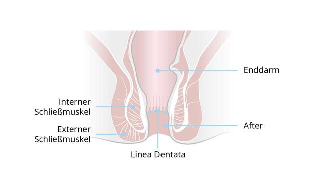 Fisteln verstehen: Ursachen, Symptome und wie man sie behandelt