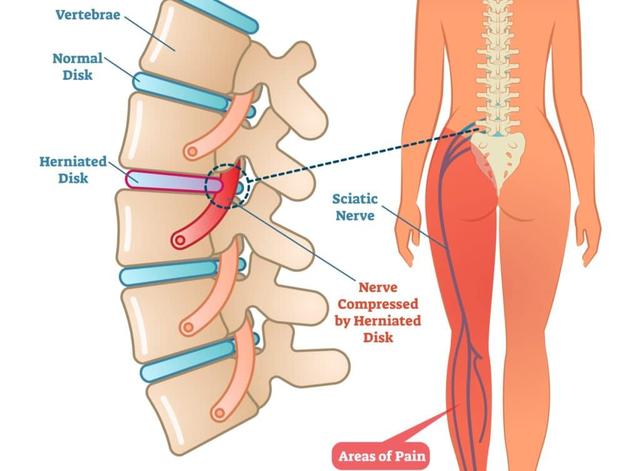 Schmerzen im Rücken? Mögliche Therapien bei eingeklemmtem Nerv