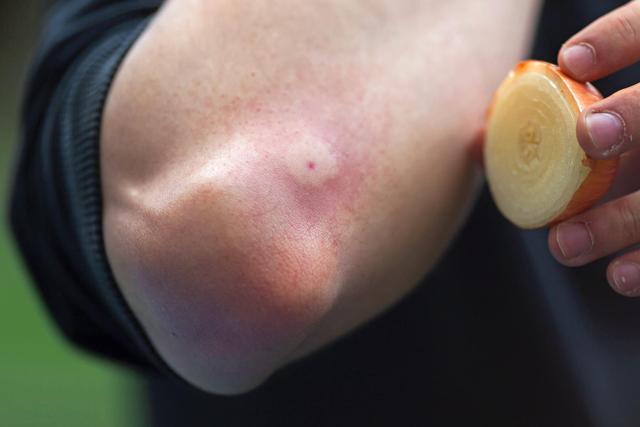 Allergische Reaktion auf Wespenstich: Symptome erkennen und richtig handeln