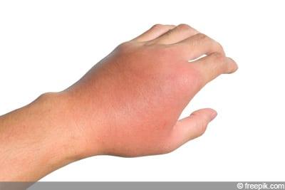 Allergische Reaktion auf Wespenstich: Was tun und wann zum Arzt?