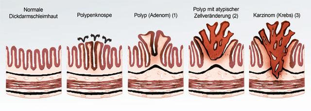 Rolle des Darms bei der Entwicklung von Darmkrebs: Ursachen und Risikofaktoren.
