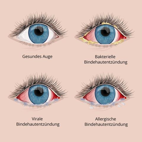 Dauer einer Bindehautentzündung: Wie lange ist sie normalerweise? Dauer einer Bindehautentzündung: Wie lange ist sie normalerweise?