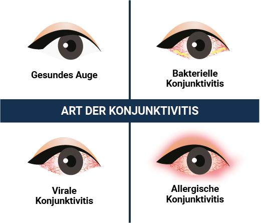 Zeitlicher Verlauf einer Bindehautentzündung Zeitlicher Verlauf einer Bindehautentzündung