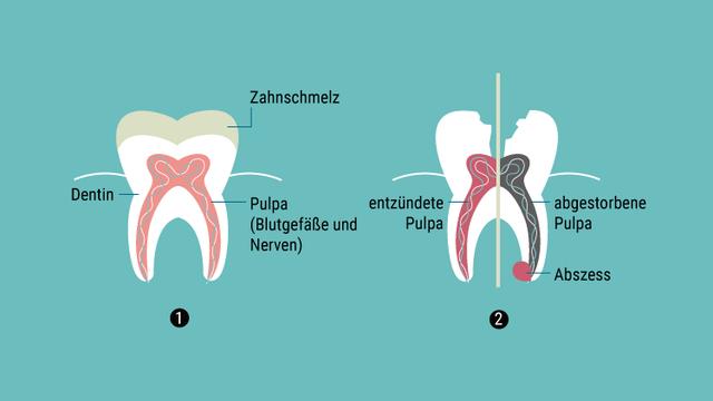 Dauer einer Zahnwurzelbehandlung: Was Sie wissen sollten Dauer einer Zahnwurzelbehandlung: Was Sie wissen sollten