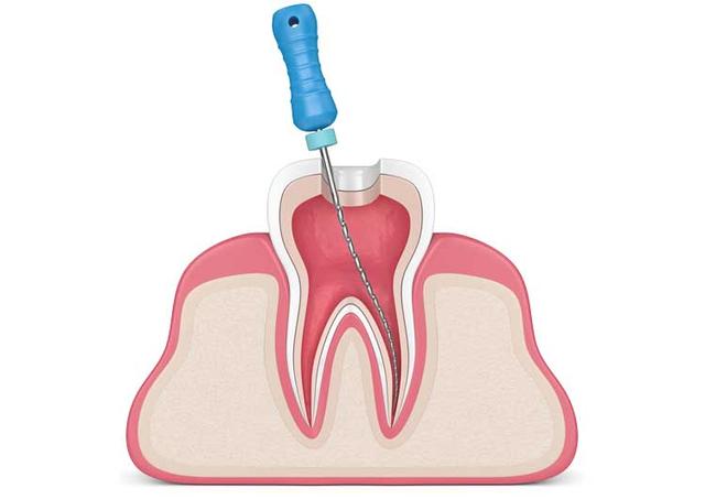 Wie lange dauern die einzelnen Schritte einer Wurzelbehandlung? Wie lange dauern die einzelnen Schritte einer Wurzelbehandlung?