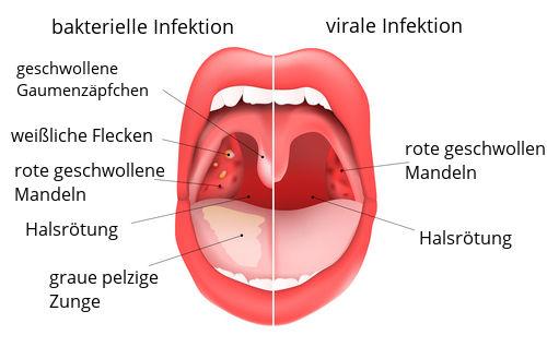 Dauer der Ansteckungsfähigkeit bei Streptokokken-Infektion Dauer der Ansteckungsfähigkeit bei Streptokokken-Infektion