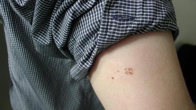 Wie oft sollte man sich einem Hautscreening unterziehen?