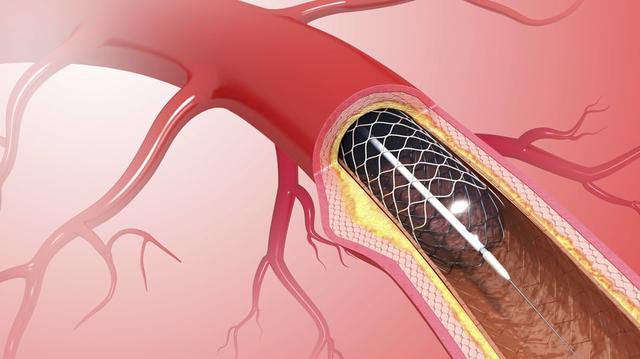 Lebensdauer und Wartung von Gefäßstützen Lebensdauer und Wartung von Gefäßstützen