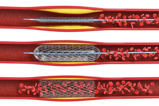 Alternative Behandlungsmöglichkeiten zu Stents bei wiederholtem Verschluss der Herzkranzgefäße Alternative Behandlungsmöglichkeiten zu Stents bei wiederholtem Verschluss der Herzkranzgefäße