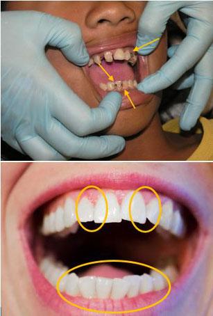 Die Bedeutung der Mundhygiene: Warum Zahnstein ein ernsthaftes Problem sein kann Die Bedeutung der Mundhygiene: Warum Zahnstein ein ernsthaftes Problem sein kann