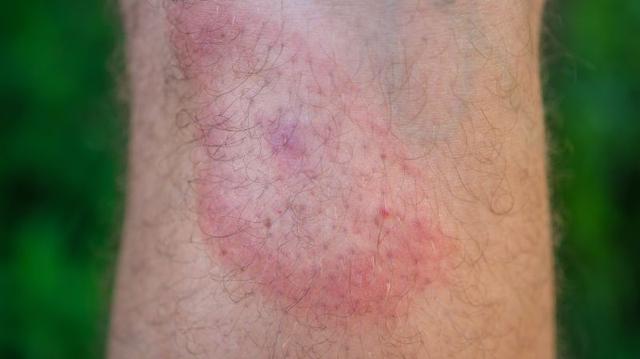 Wann sollte man bei einem Zeckenbiss zum Arzt gehen? Bilder und Informationen Wann sollte man bei einem Zeckenbiss zum Arzt gehen? Bilder und Informationen