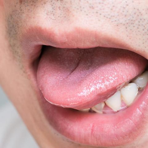 Tipps zur Behandlung einer verbrannten Zunge: Was du tun kannst