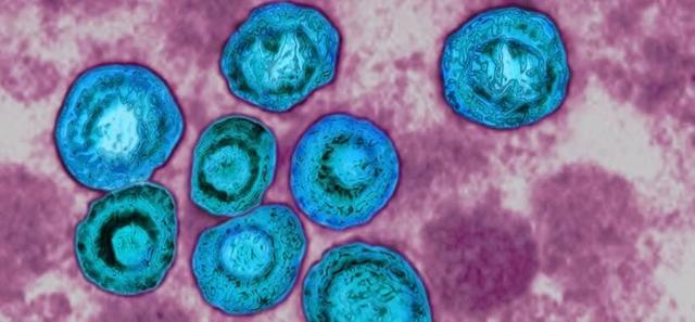 Kongenitale CMV-Infektion: Die häufigste infektiöse Ursache für geistige Behinderung im Kindesalter Kongenitale CMV-Infektion: Die häufigste infektiöse Ursache für geistige Behinderung im Kindesalter